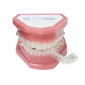 Behandlung mit Invisalign Teen